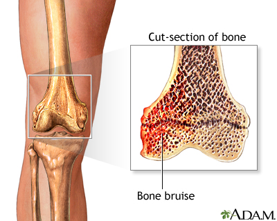 bone-bruise.jpg